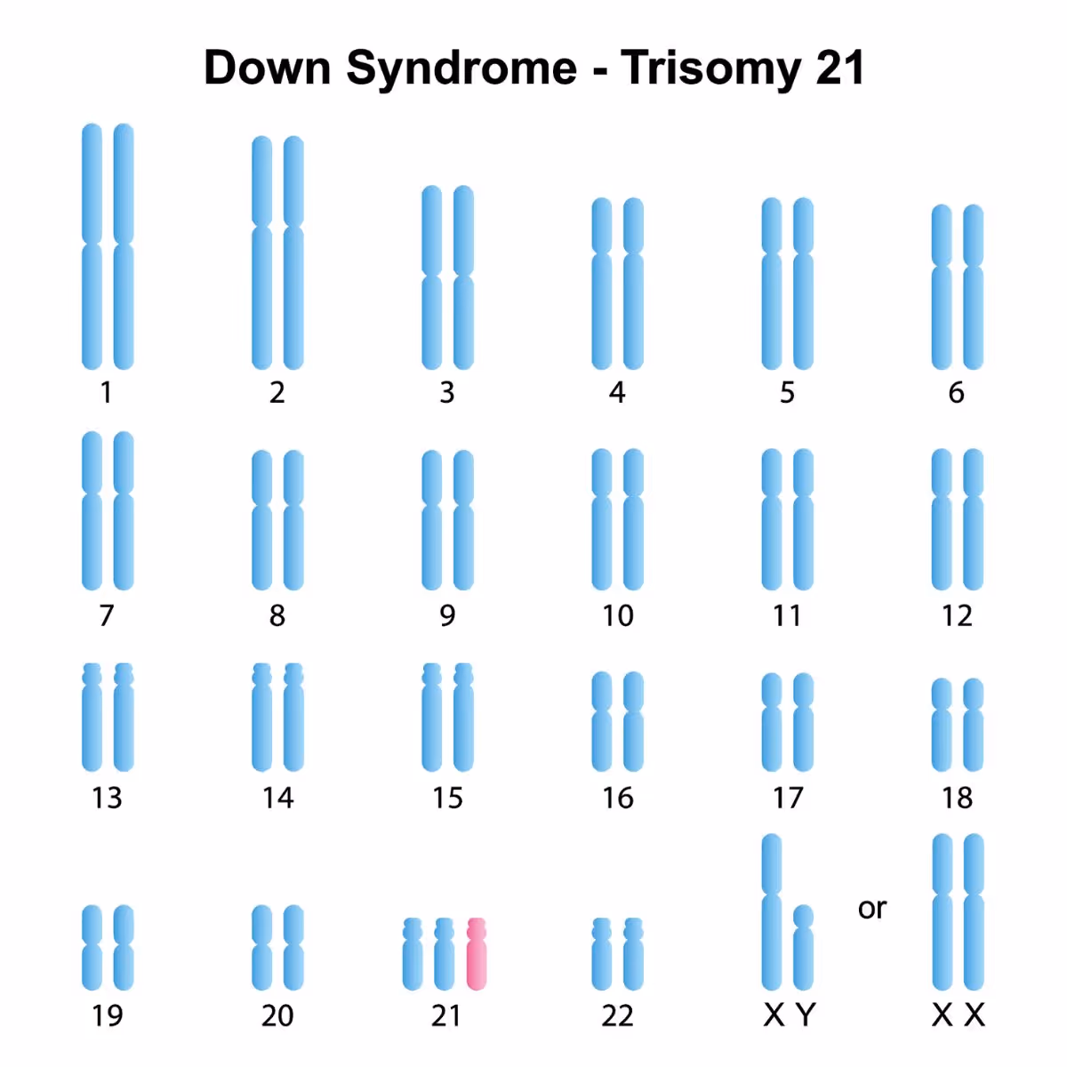 ดาวน์ซินโดรม เกิดจากสาเหตุ - What causes Down syndrome?