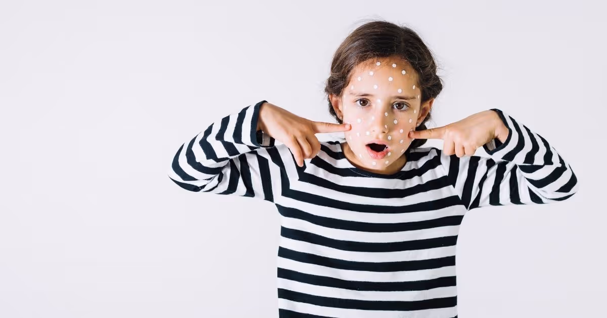 อาการและวิธีรักษาวัคซีนโรคอีสุกอีใส (Chickenpox)