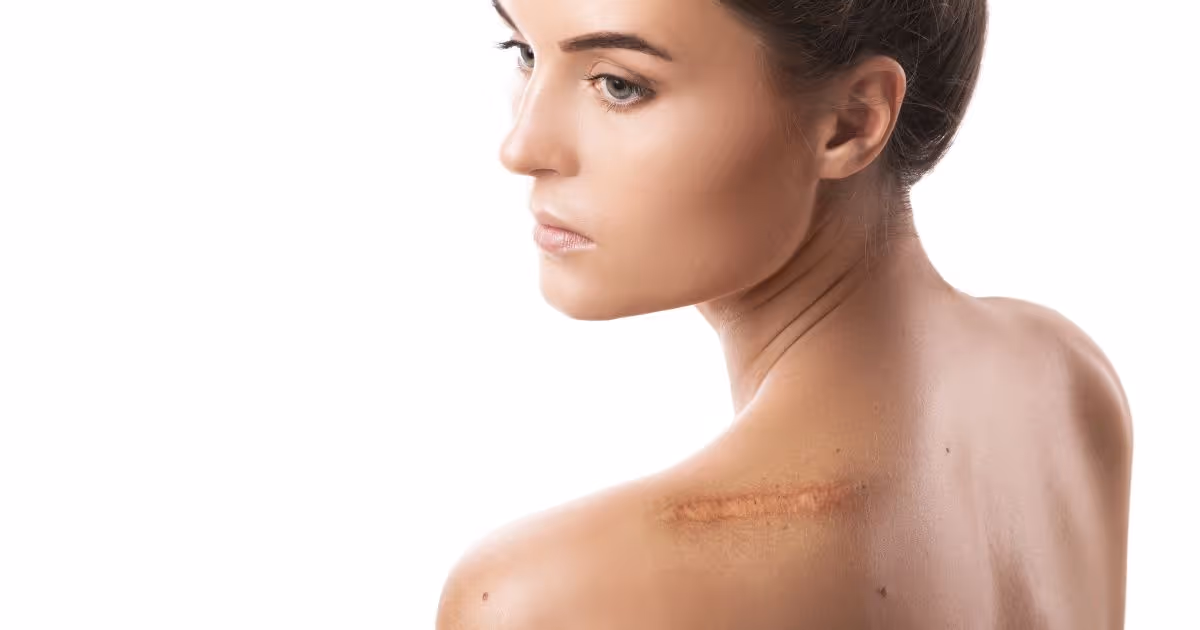รักษาแผลคีลอยด์ ด้วยการฉายแสง แผลนูนหนา แผลผ่าตัด ผ่าคลอด - Radiation therapy for keloid scars: Keloid scar treatment