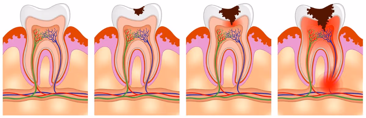 Root Canal Treatment Banner 3