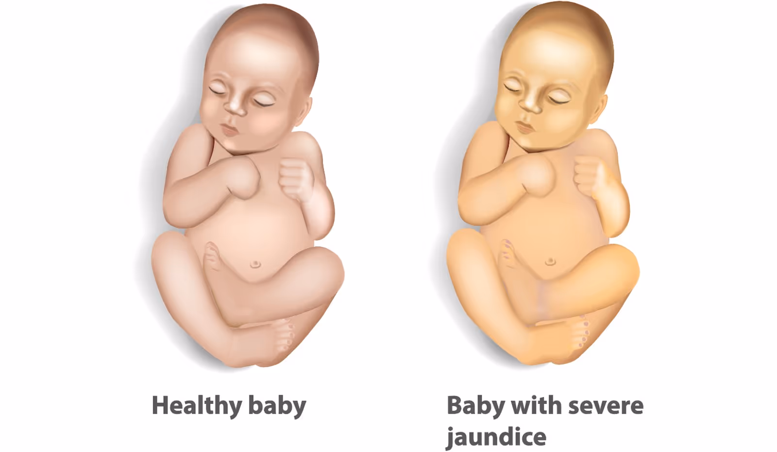 Jaundice in newborns: healty baby and baby with severe jaundice