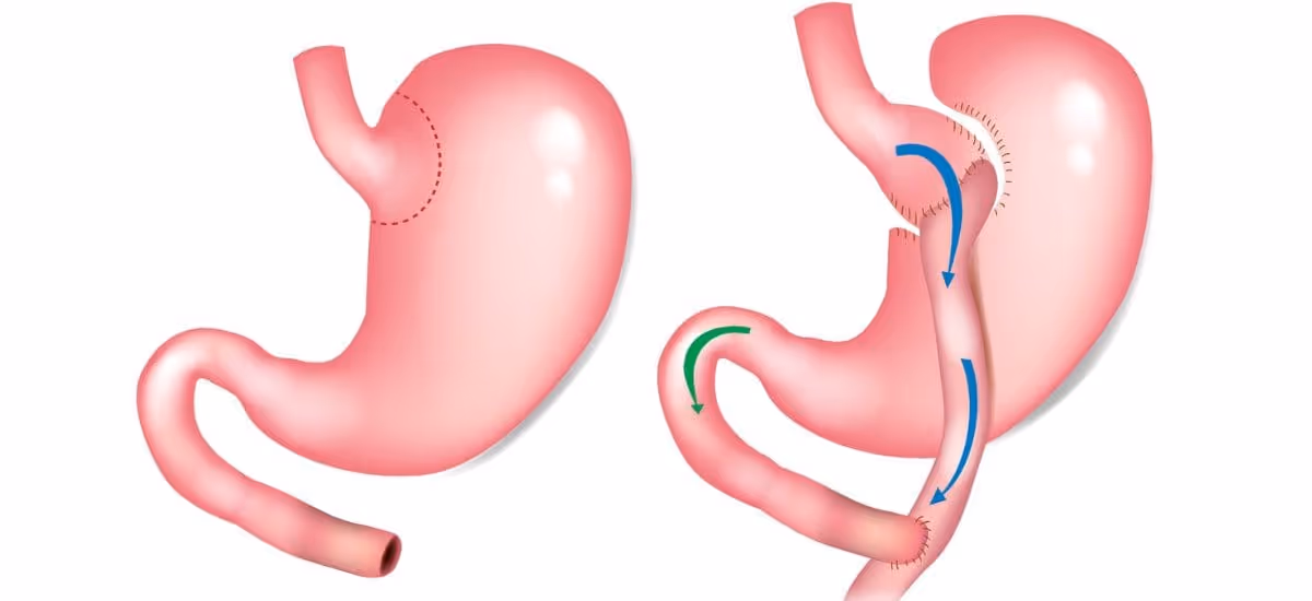 รูปการผ่าตัดแบบบายพาส (Roux-en-Y gastric bypass: RYGB)