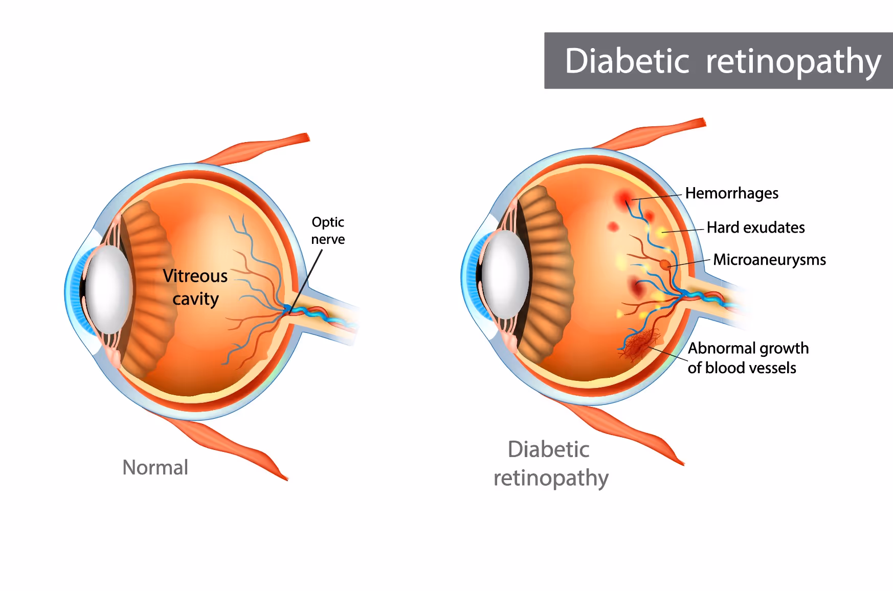 เบาหวานขึ้นตา เกิดจาอะไร? - Diabetic Retinopathy