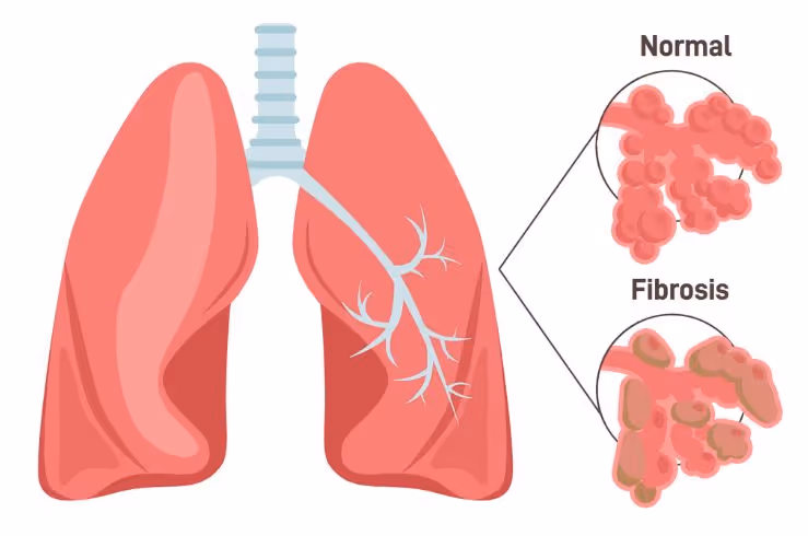 สาเหตุของการเกิดพังผืดในปอด - Pulmonary Fibrosis
