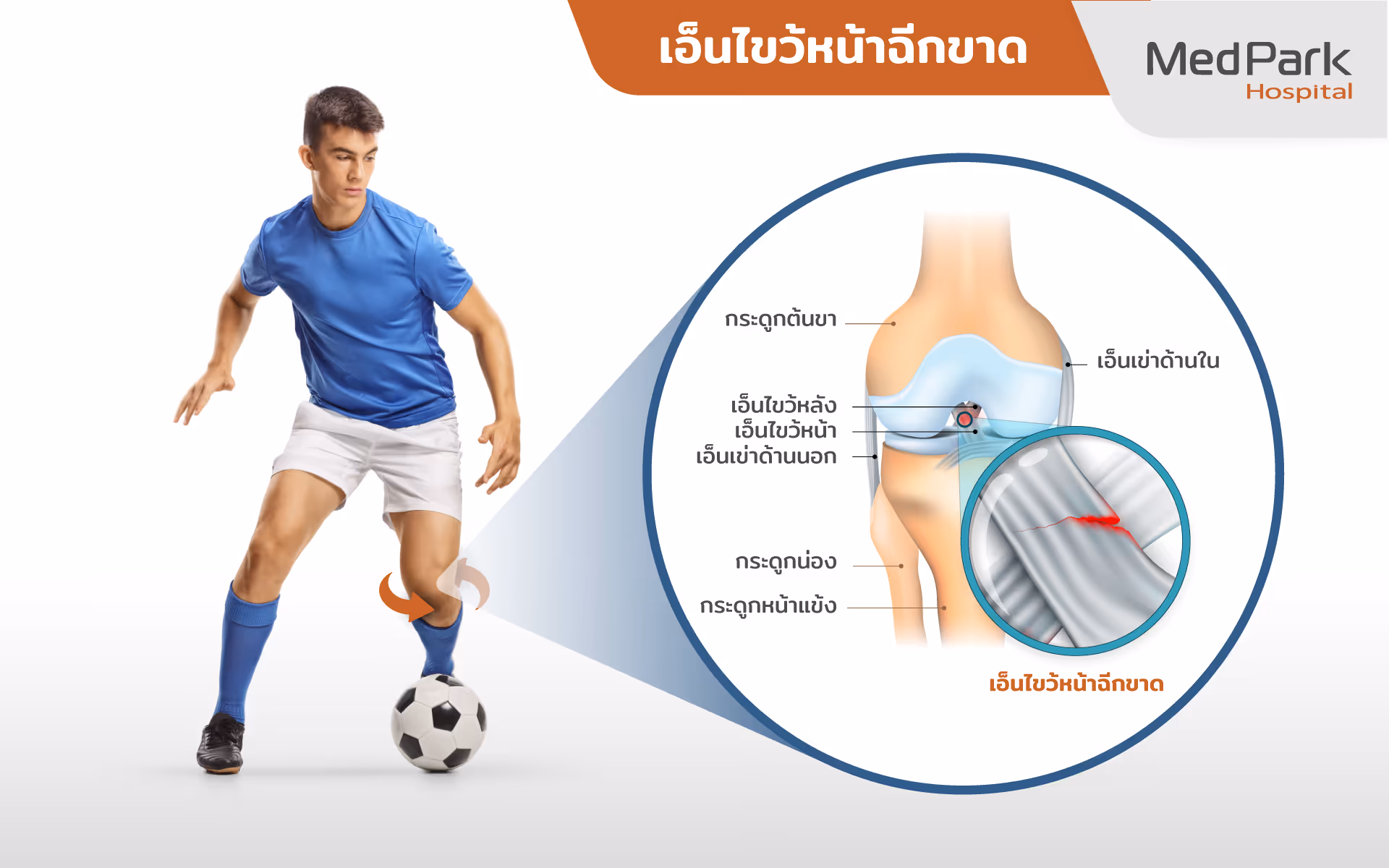 Acl Reconstruction (1 1)