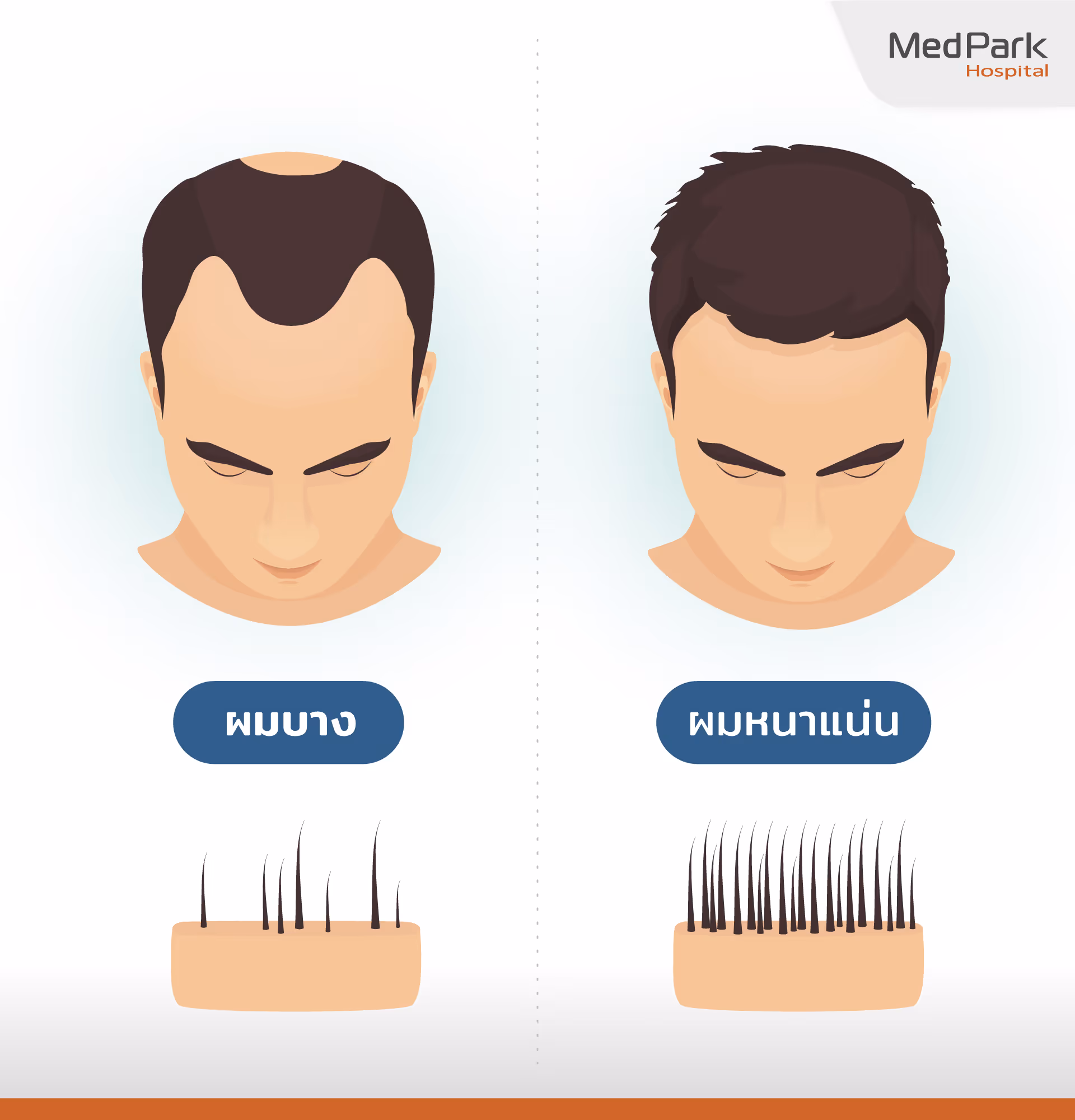 ผลลัพธ์หลังการปลูกผม FUE