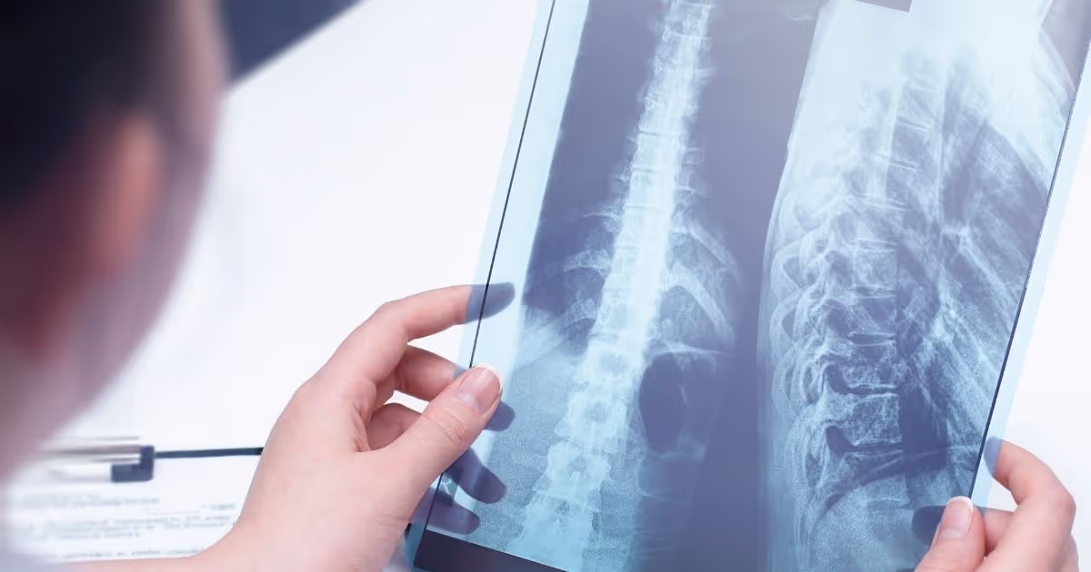 ผ่าตัดกระดูกสันหลังแบบแผลเล็ก หรือแบบรุกล้ำน้อย (Minimally Invasive Spine Surgery - MIS)