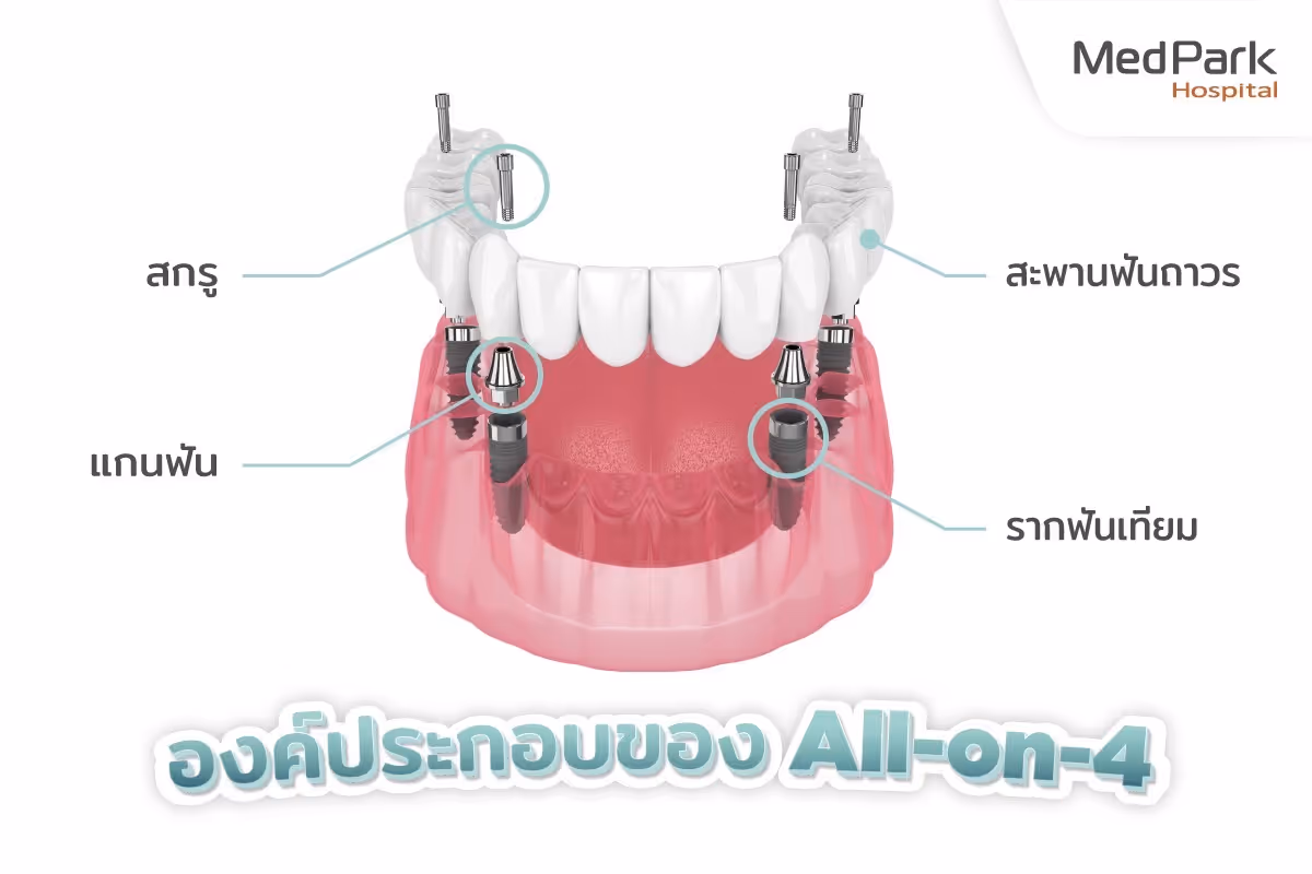 All on 4 มีส่วนประกอบ อะไรบ้าง-Component of All on 4