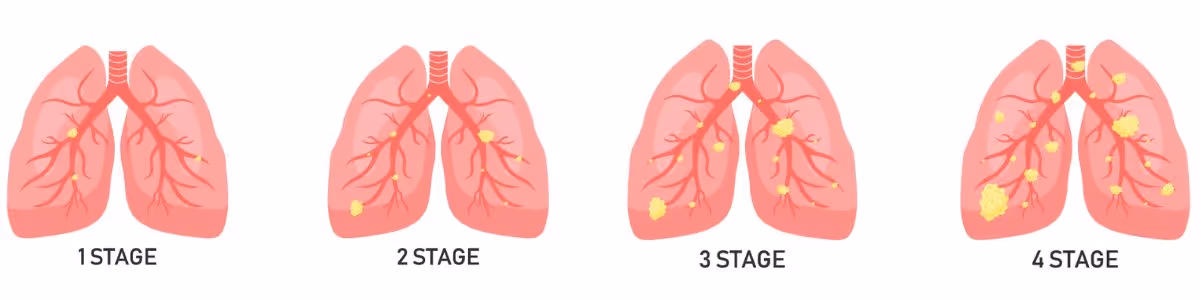 There are 4 stages of non-small cell lung cancer