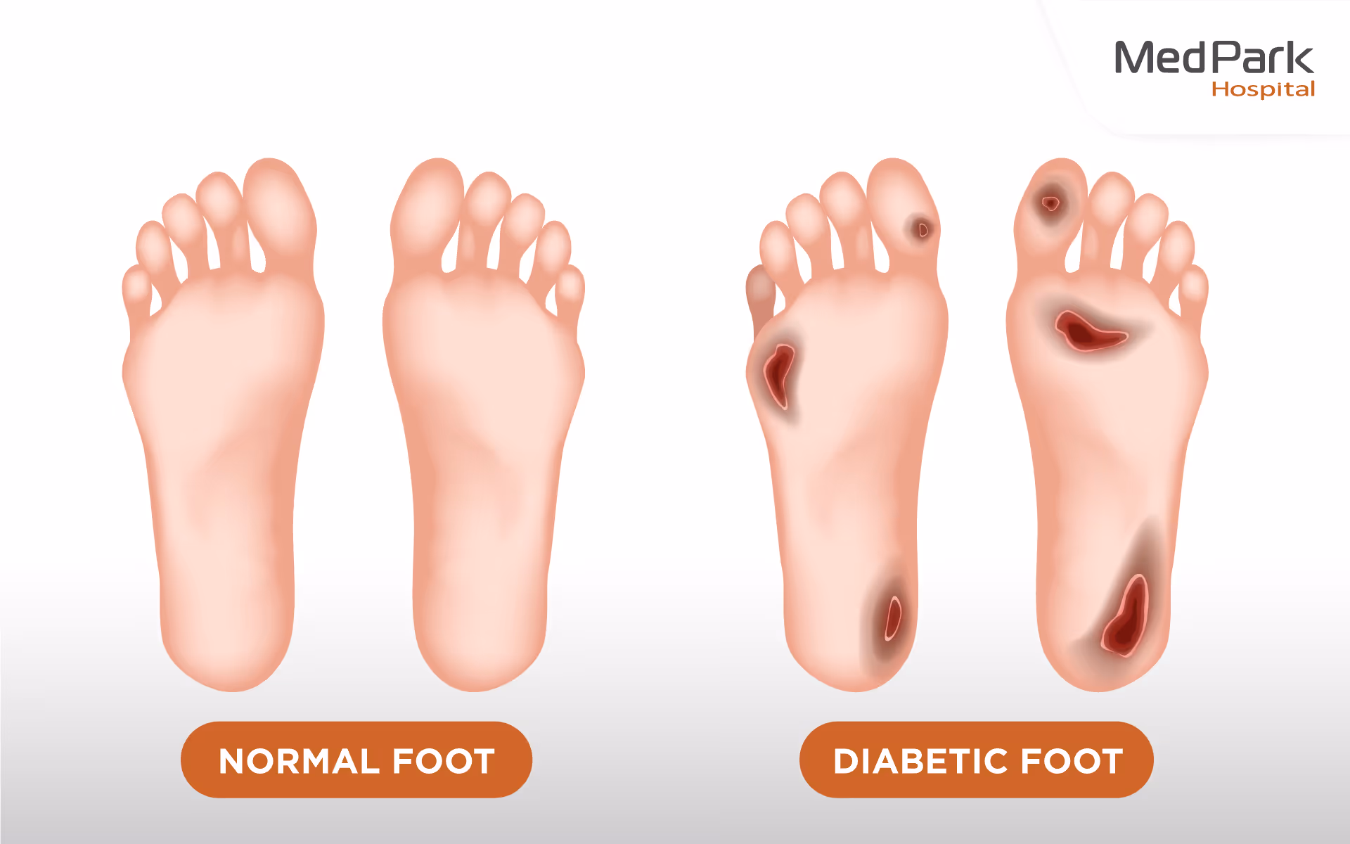 Hyperbaric Oxygen Therapy En