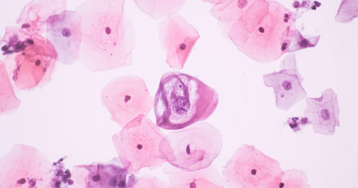 ภาพจากการตรวจ pap smear ที่พบเชื้อ HPV - Photomicrograph of Paps smear: Inflammatory smear with HPV related changes. Human Papillomavirus (hpv) Test