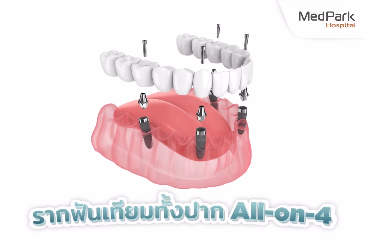 สะพานฟัน All on 4-All on 4 dental implants