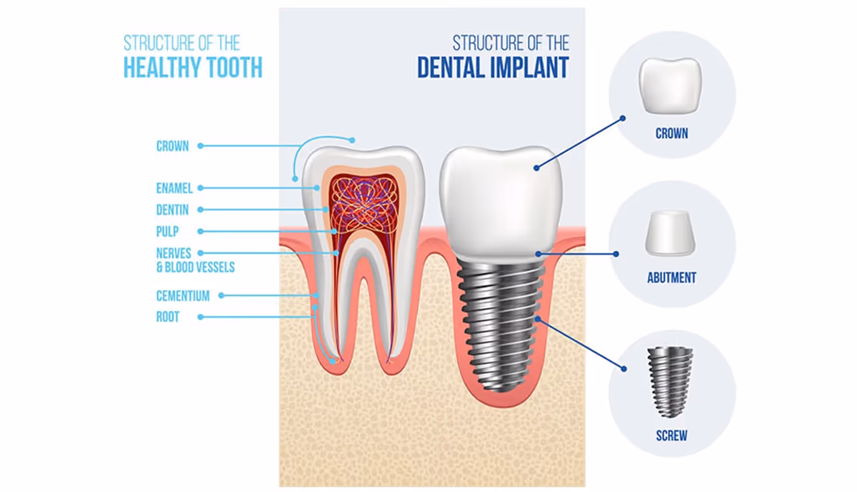 Parts of the dental implant equipment-ชิ้นส่วนของอุปกรณ์การใส่รากฟันเทียม