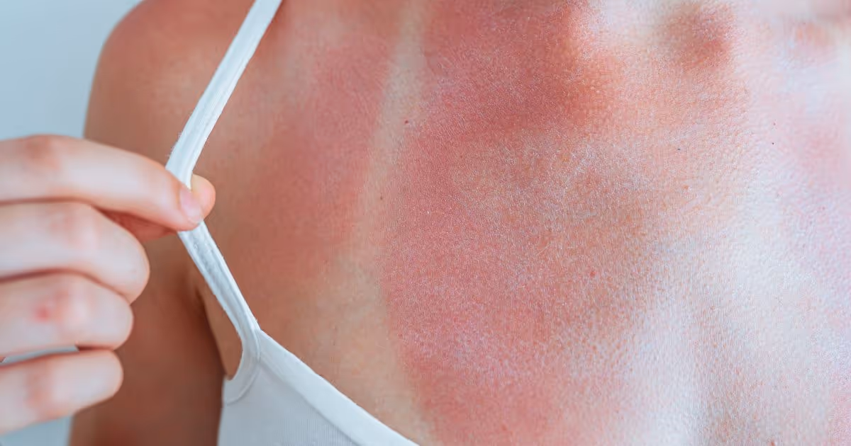 อาการผิวไหม้แดด - The symptoms of sunburn