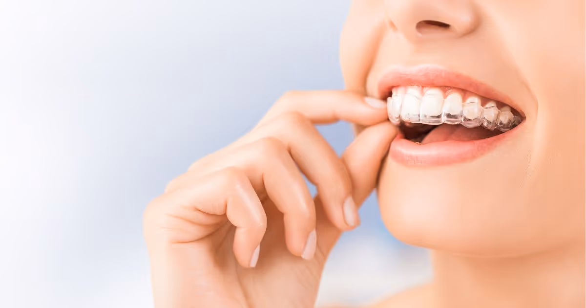 Invisalign จัดฟันใส ขั้นตอน ข้อดี มีกี่แบบ เหมาะกับใคร