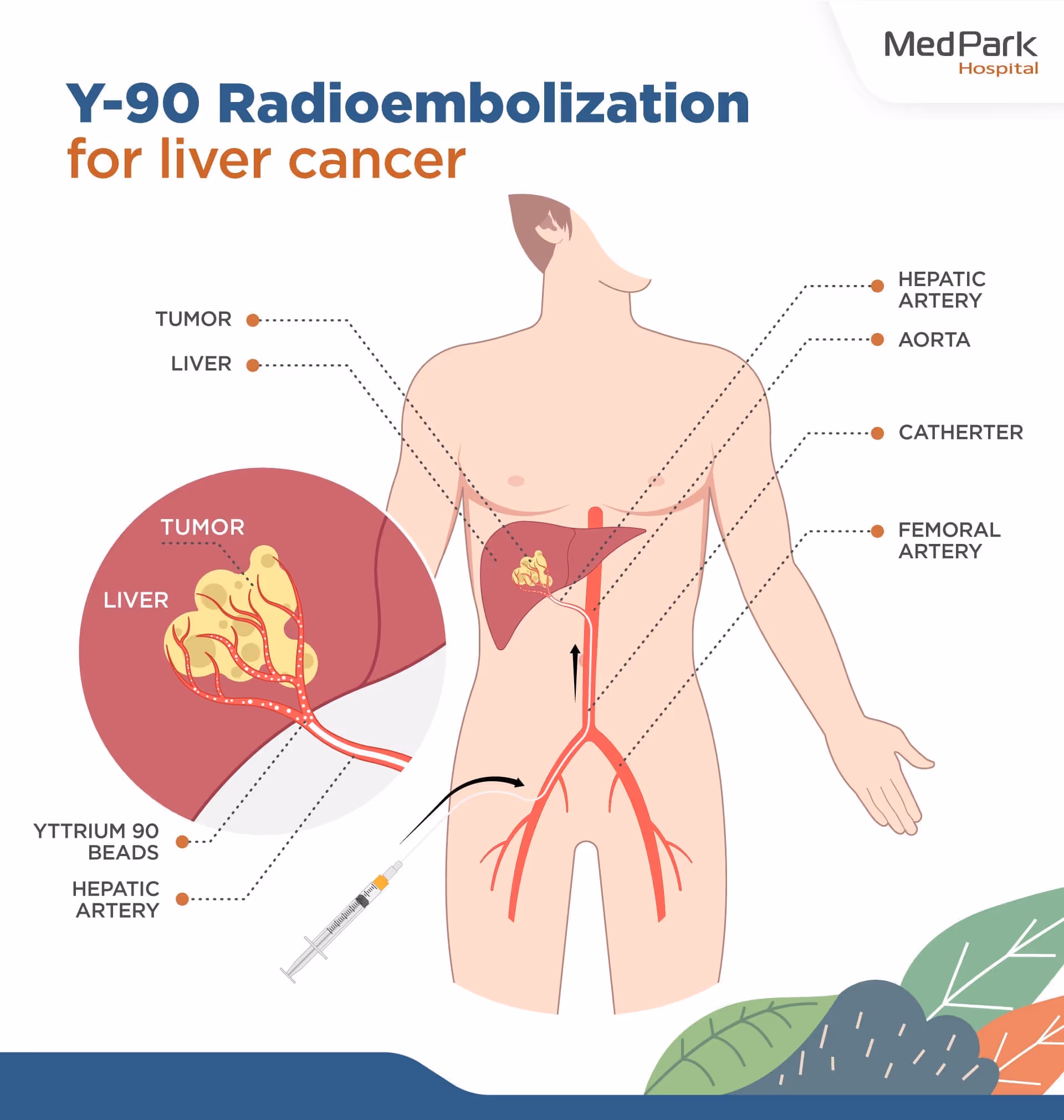 Y 90 Radioembolization for Liver Cancer 3