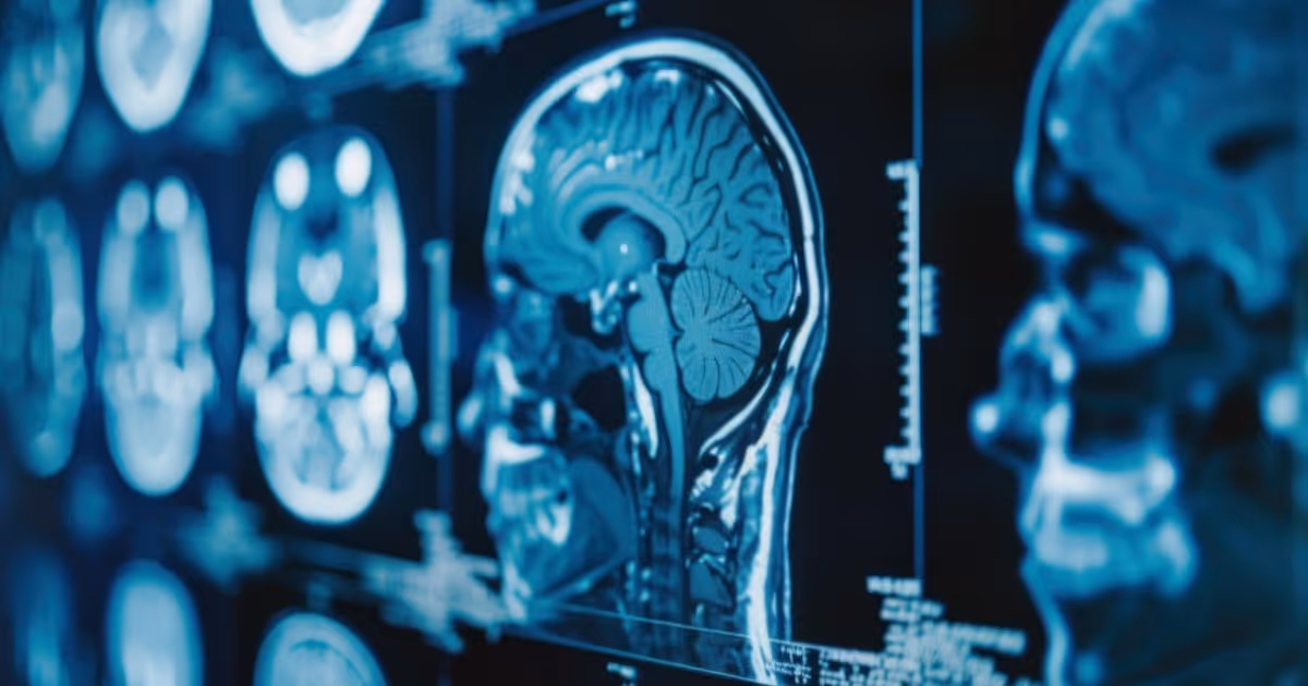 Brain MRI: การตรวจ MRI สมองมีความเสี่ยงหรือไม่ การตรวจ MRI สมองเป็นการตรวจที่มีความปลอดภัยสูง แต่มีความเสี่ยงบางประการที่ควรทราบ
