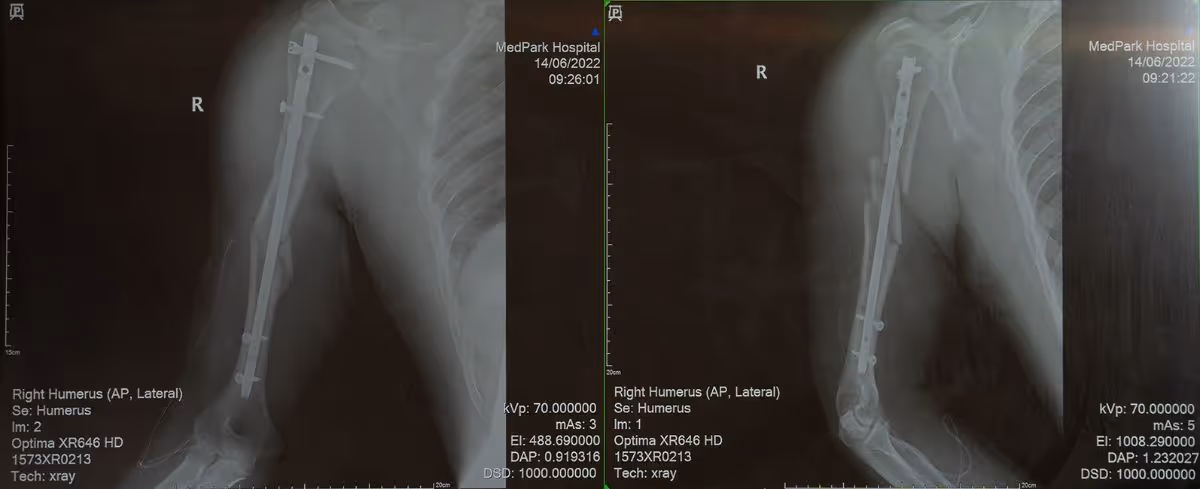 Right Humerus