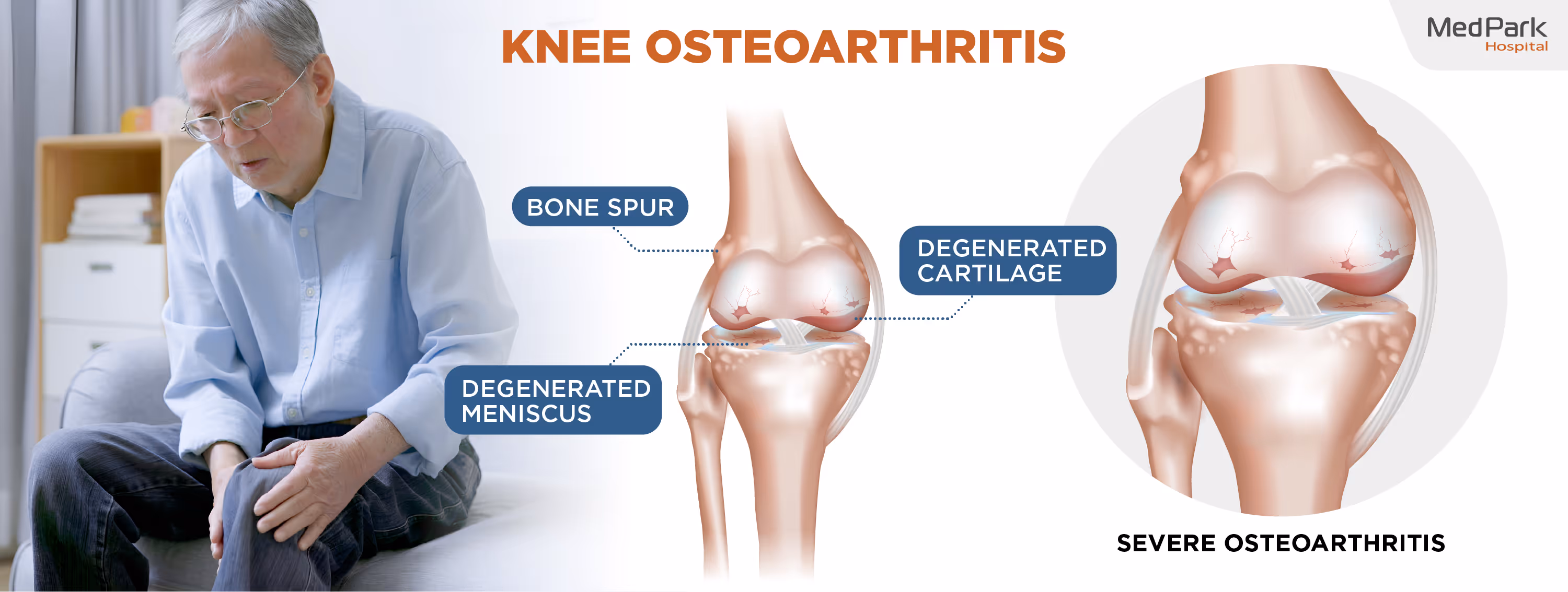 Severe knee Osteoarthritis
