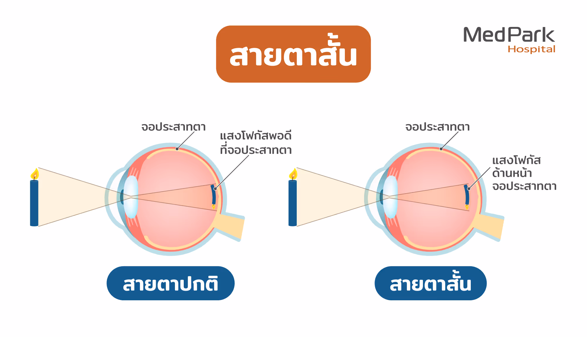 Myopia 1
