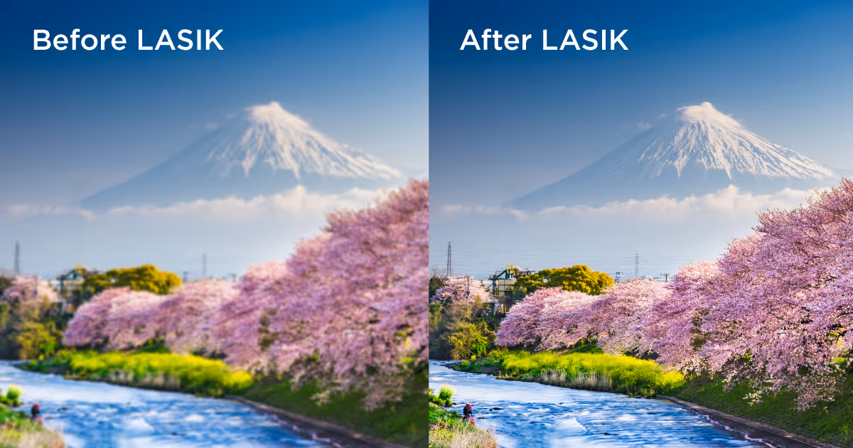 ข้อดีของการทำ LASIK (ก่อน-หลังทำ SMILEpro)