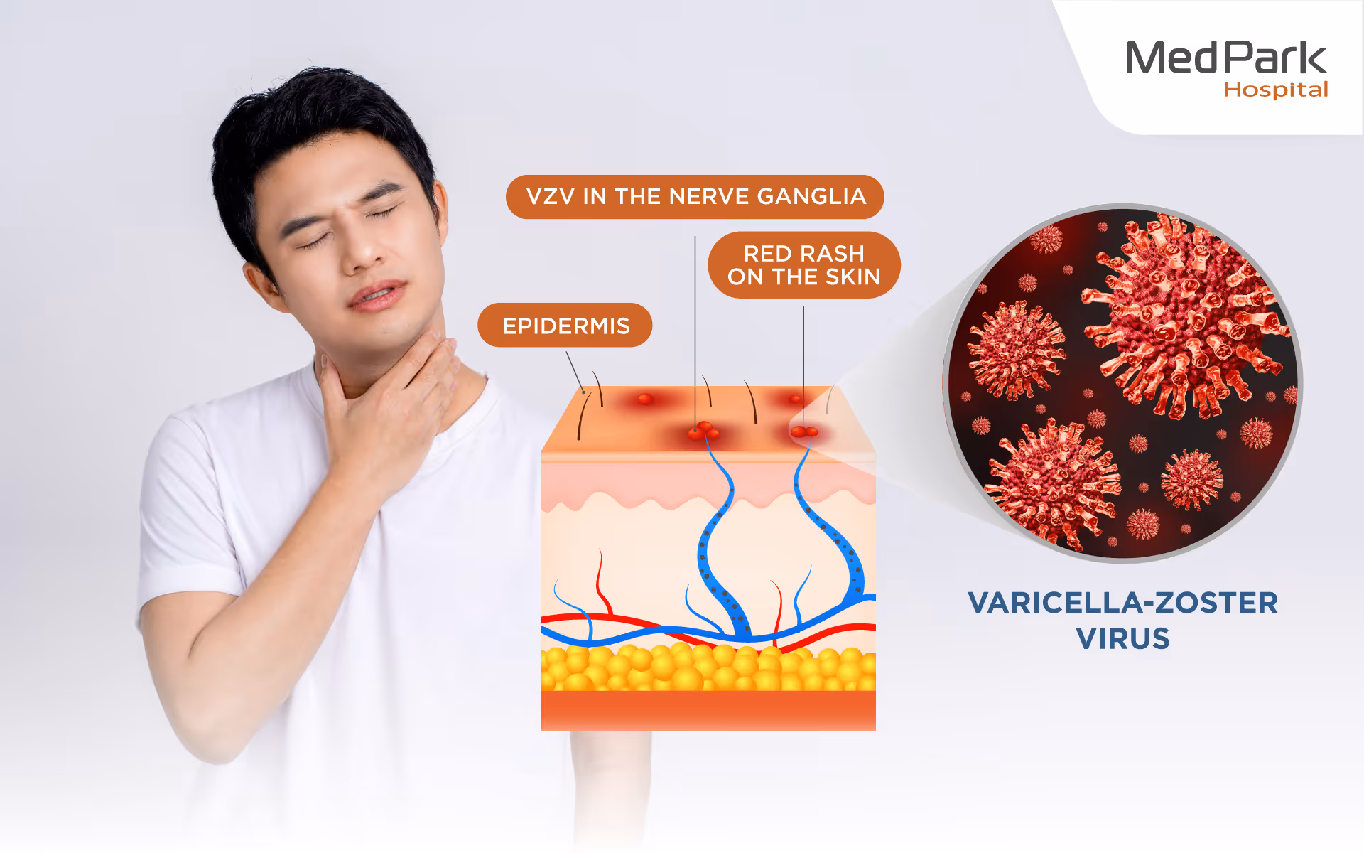 Causes of Herpes Zoster