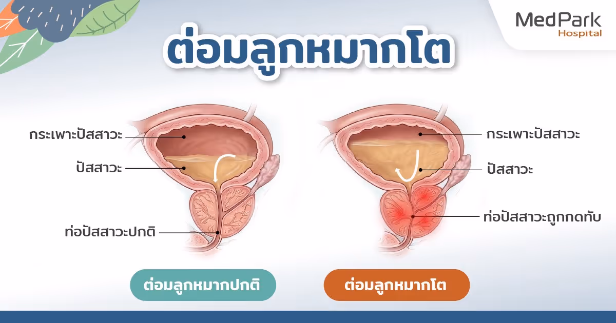 ต่อมลูกหมากโตกดทับท่อปัสสาวะ