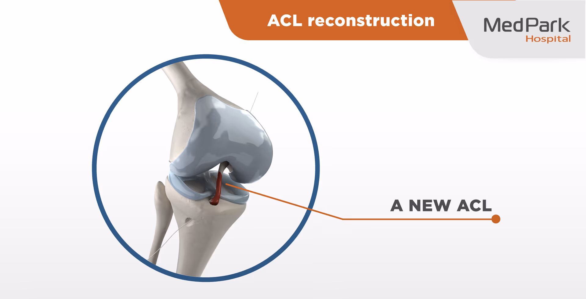 Acl Reconstruction (3 2)