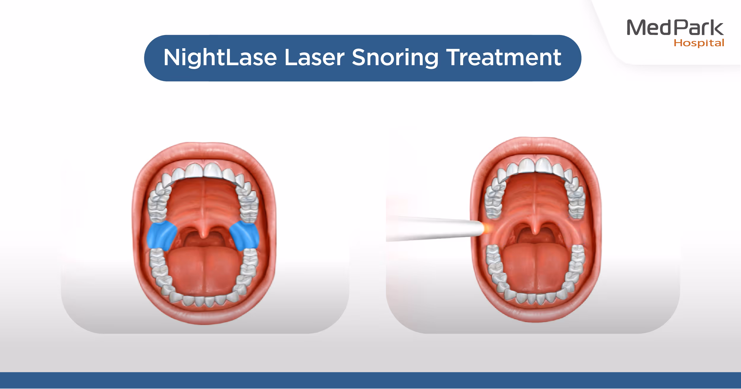 What is a laser snoring treatment procedure?